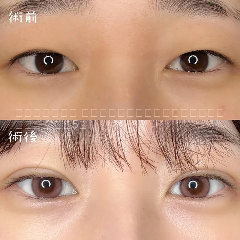 二重埋没法　No.10