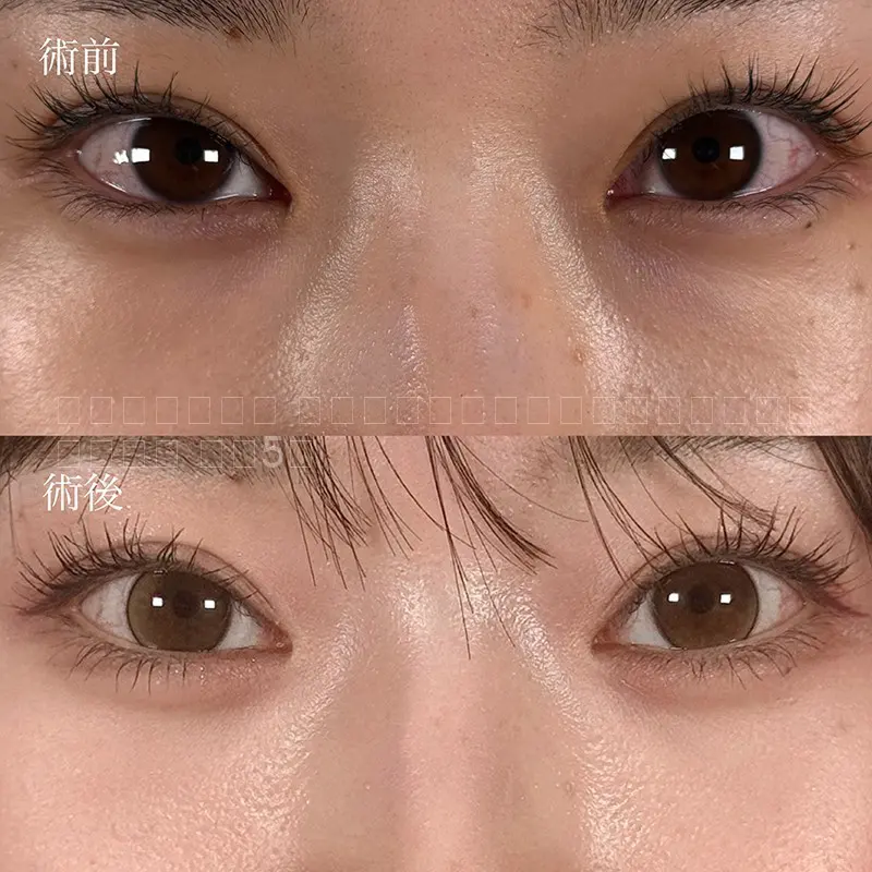 切らないクマ取り