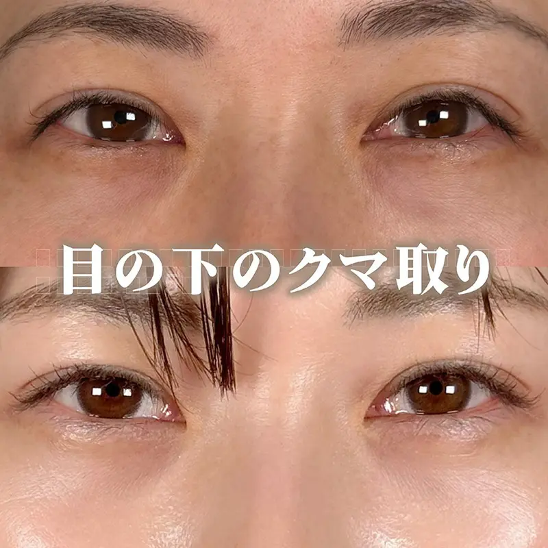 切らないクマ取り