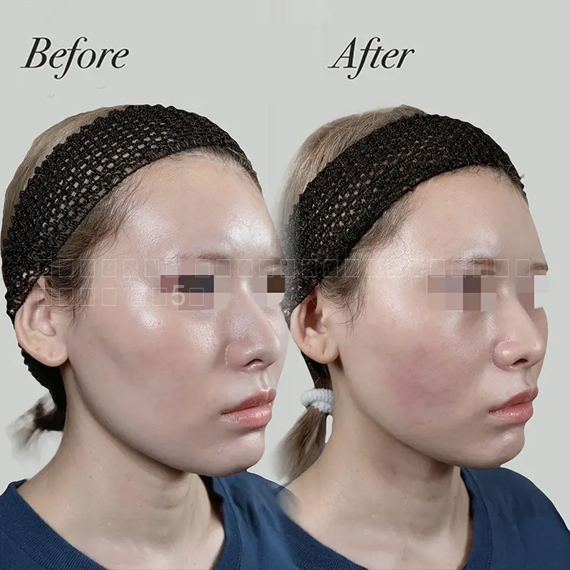 ヒアルロン酸注射