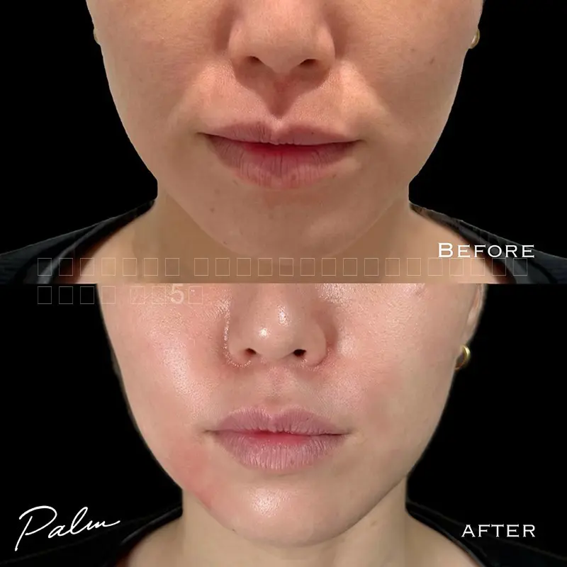 ヒアルロン酸注射