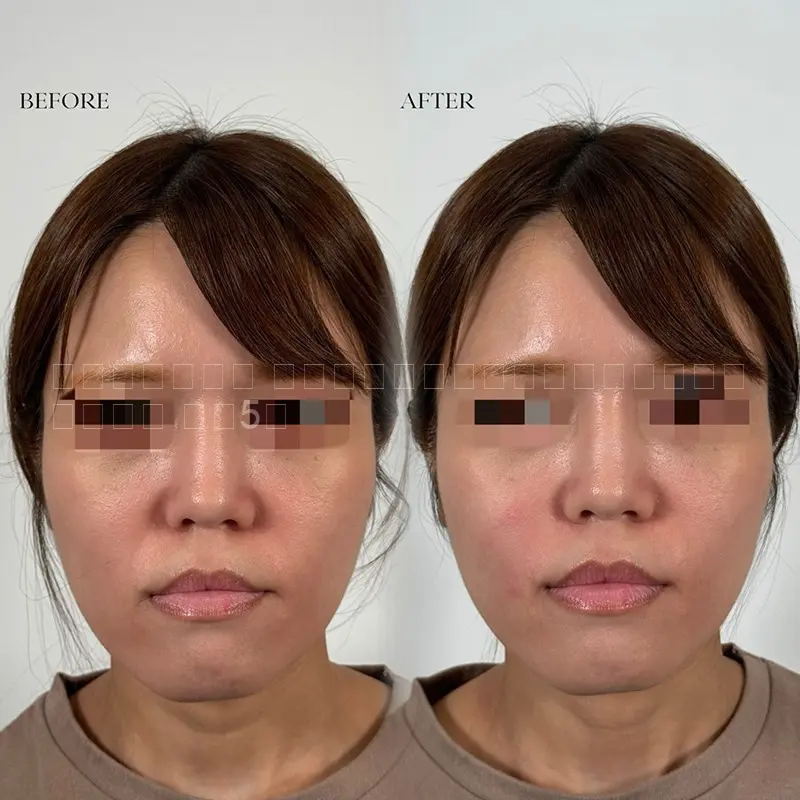 ヒアルロン酸注射