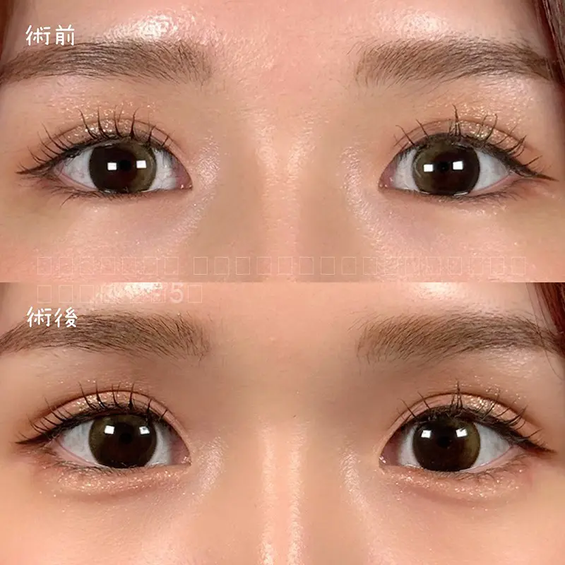 ヒアルロン酸注射