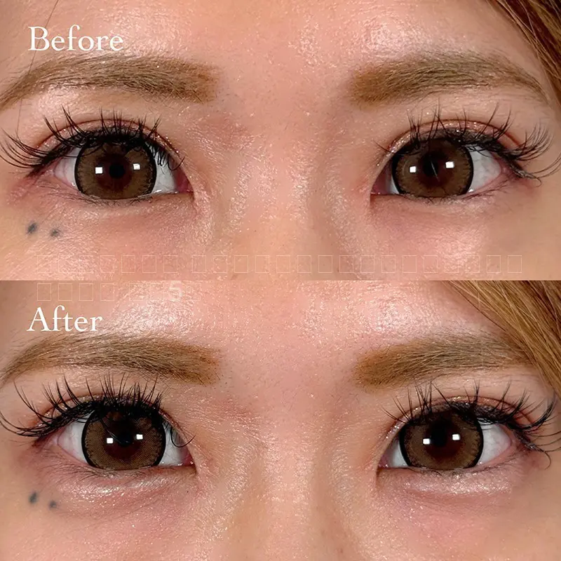 ヒアルロン酸注射