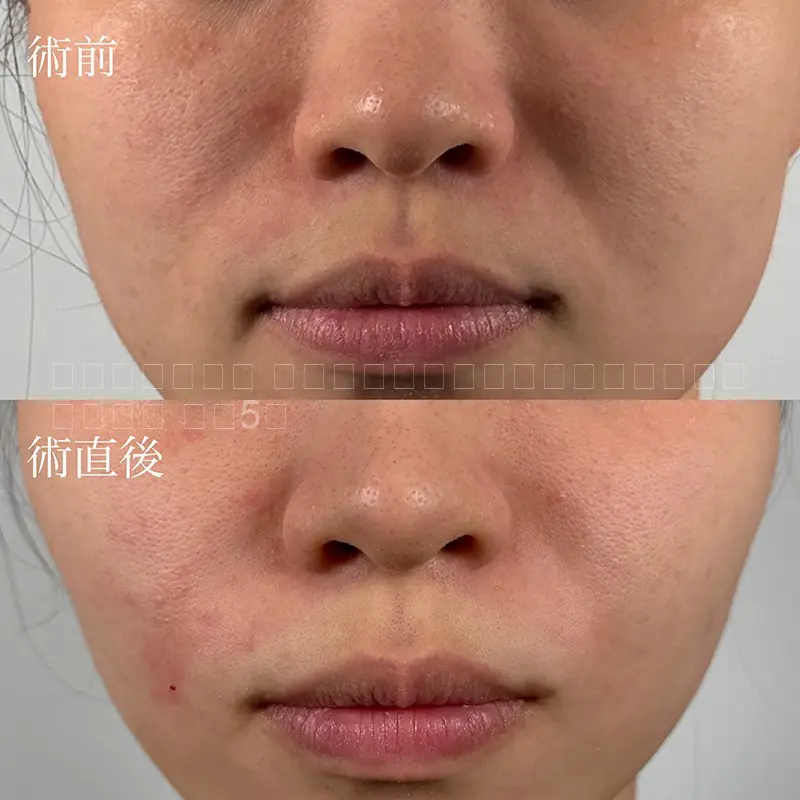 ヒアルロン酸注射