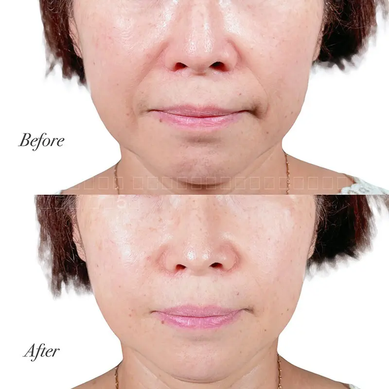 ヒアルロン酸注射