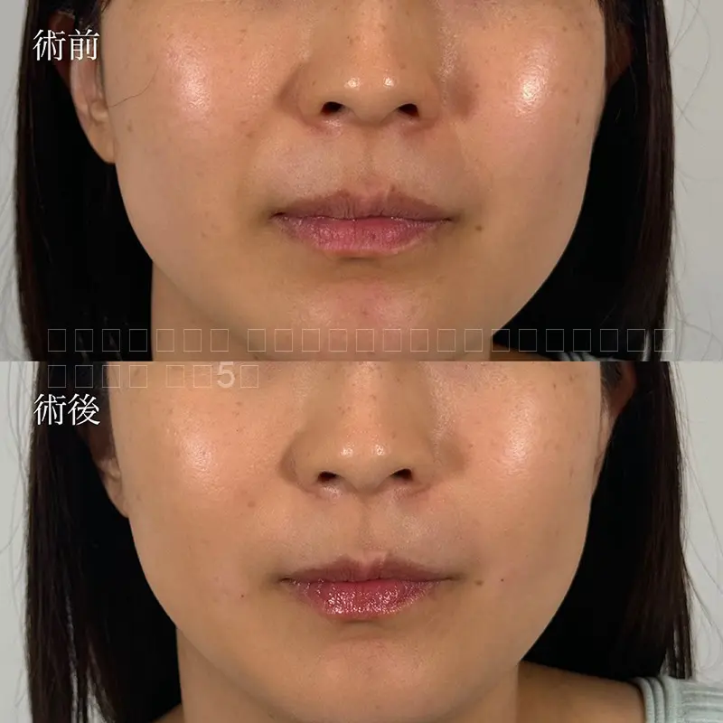 ヒアルロン酸注射