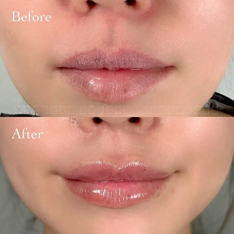 唇ヒアルロン酸注射