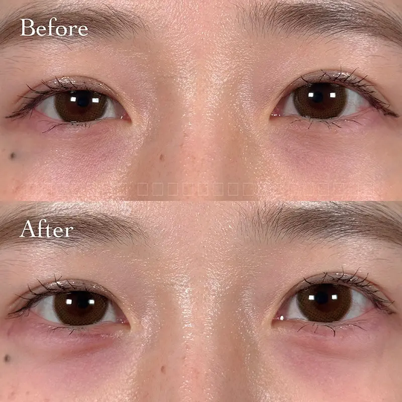 涙袋ヒアルロン酸注射