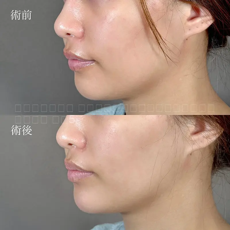 顎ヒアルロン酸注射