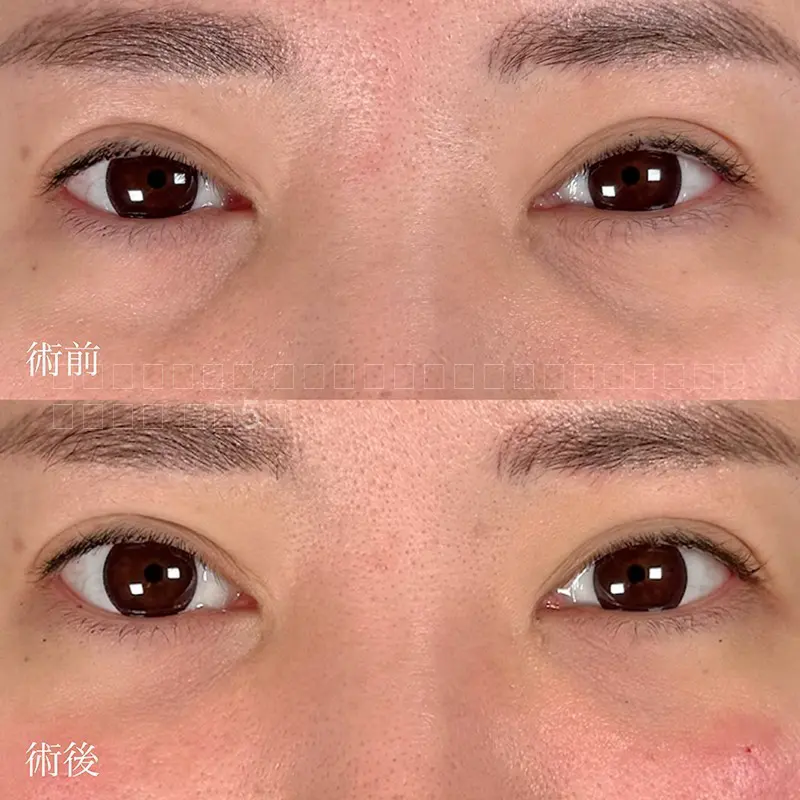 ヒアルロン酸注射