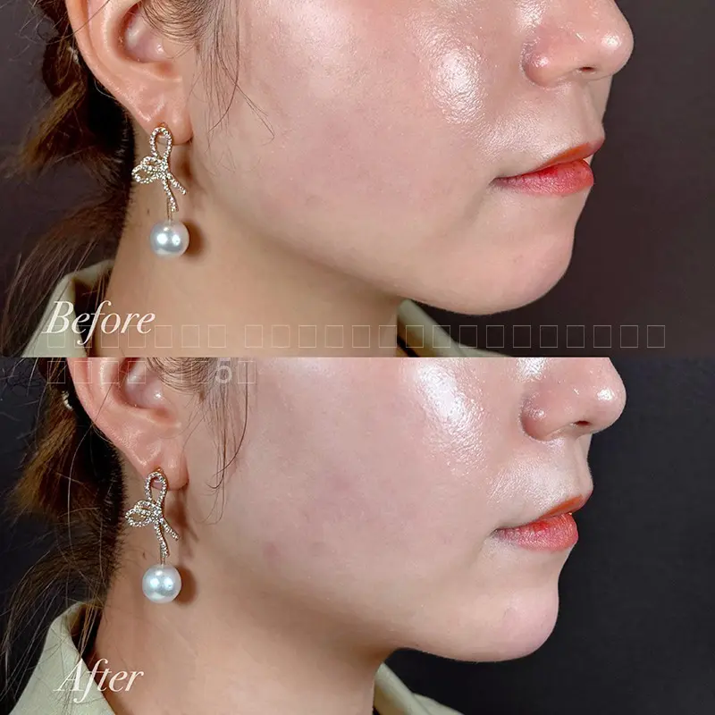 顎ヒアルロン酸注射　No.53