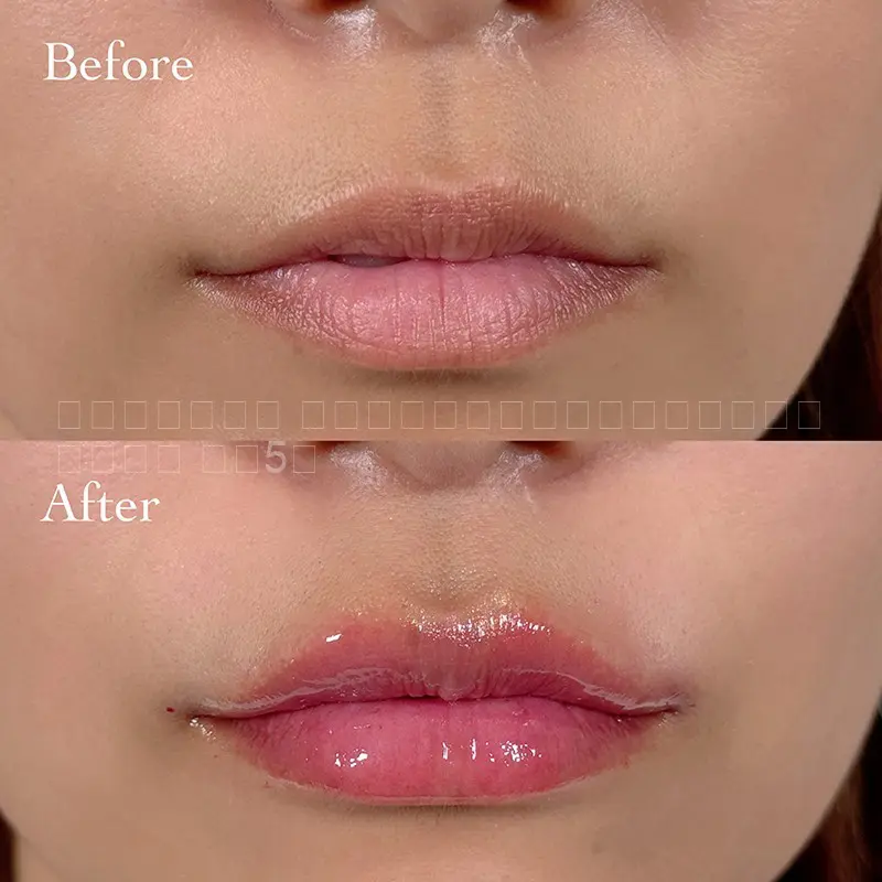 唇ヒアルロン酸注射