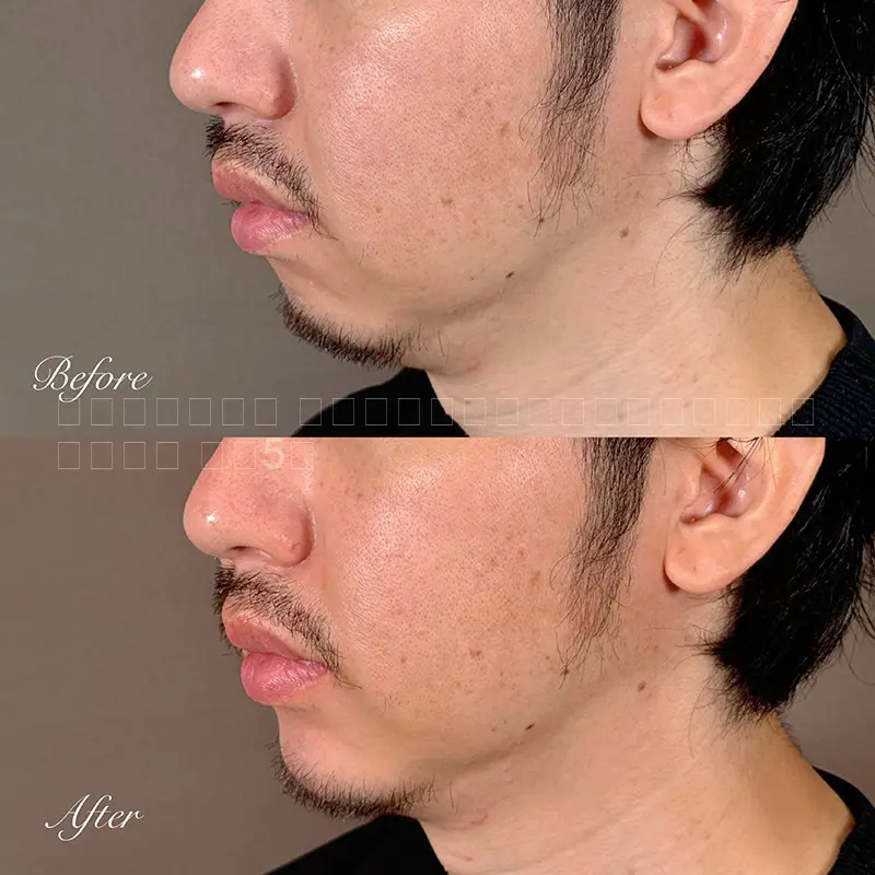 顎ヒアルロン酸注射