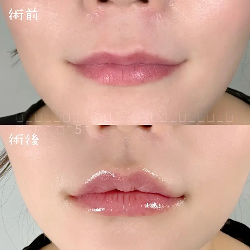 唇ヒアルロン酸注射　No.57