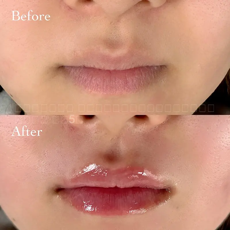 唇ヒアルロン酸注射