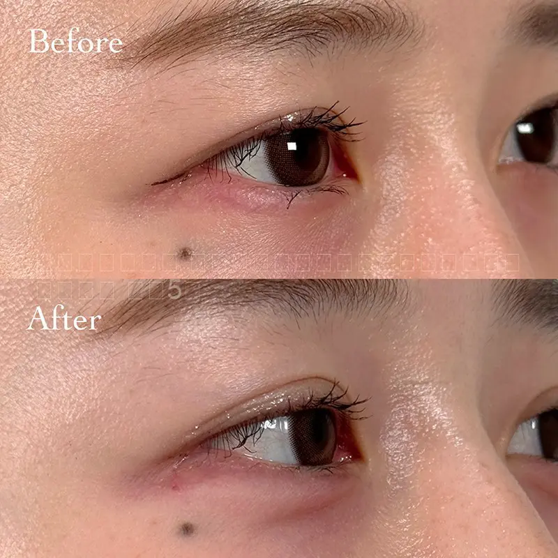 涙袋ヒアルロン酸注射