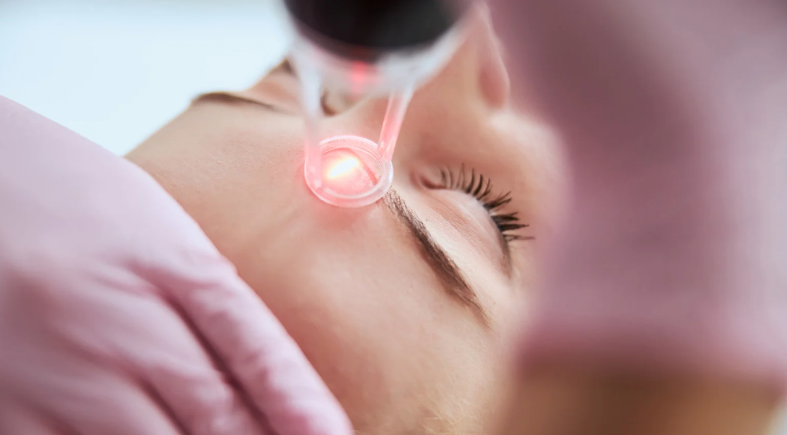 ポテンツァでニキビ跡治療！効果・回数・費用・リスクを徹底解説