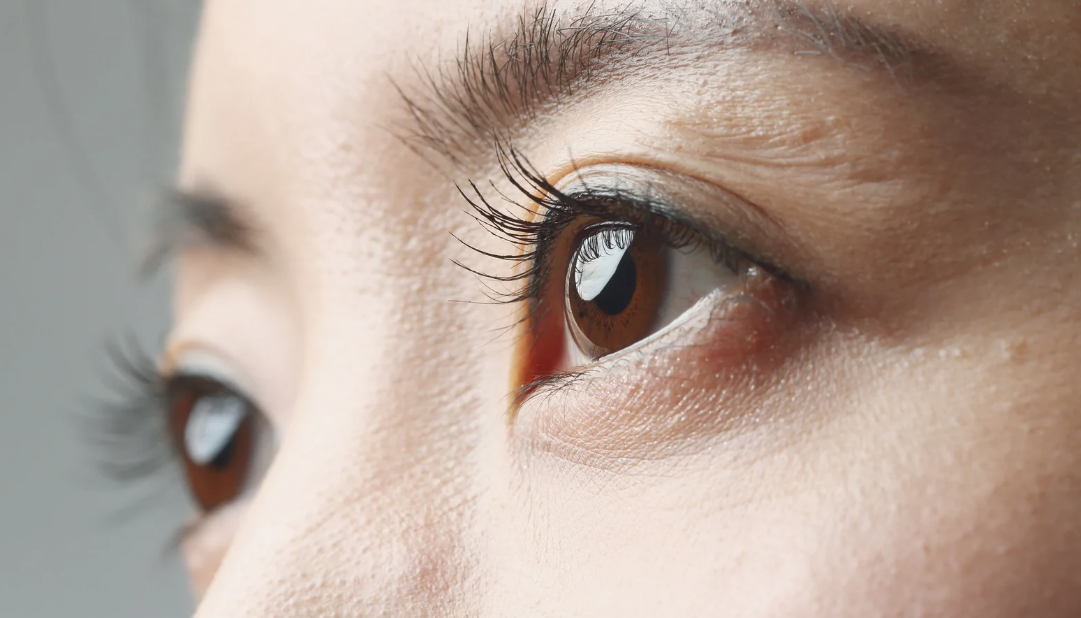 二重埋没の点数で変わる仕上がりとおすすめ