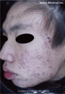 ニキビ跡治療（5回）