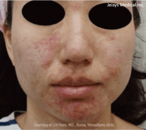 ニキビ治療（3回）