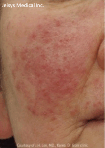 酒さ治療（3回）