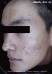 ニキビ治療（3回）