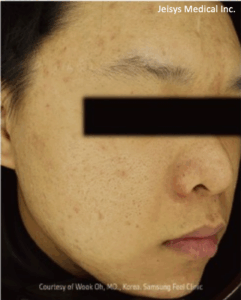 ニキビ跡治療（2回）