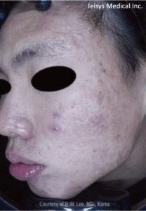 ニキビ跡治療（5回）