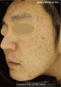 ニキビ跡治療（4回）