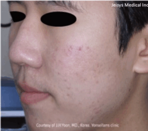 ニキビ治療 （1回）