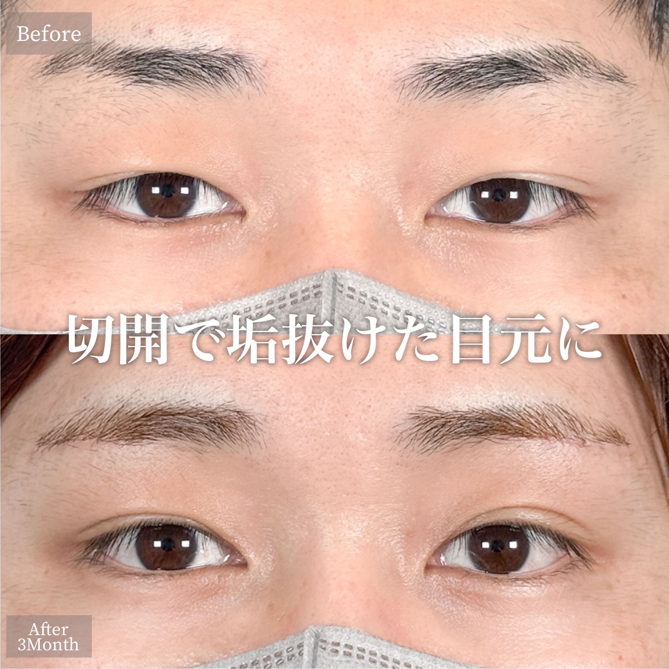 眉下切開（眉下リフト）
