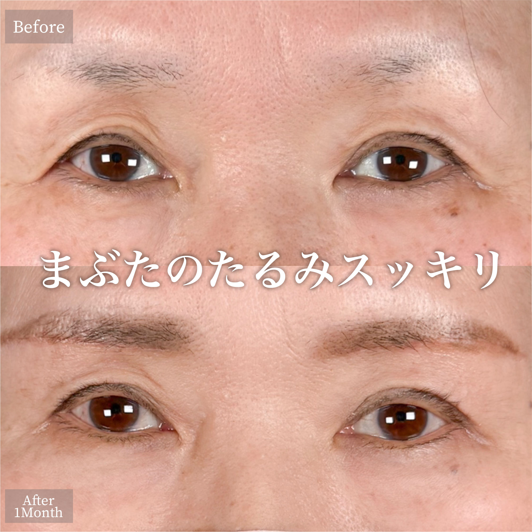 眉下切開（眉下リフト）